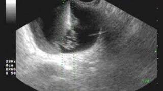 SONOGRAPHY GUIDED OVARIAN CYST ASPIRATION [upl. by Alwin]