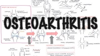 Osteoarthritis Overview causes pathophysiology investigations treatment [upl. by Valaria]