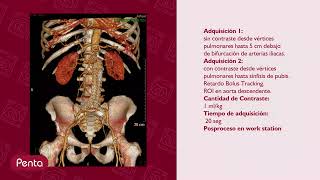 Angiotomografía de aorta abdominal  Estudio Médico Técnico [upl. by Notrab]