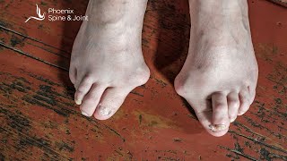 What is the best approach for bunion surgery [upl. by Larisa]