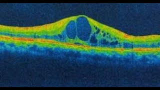 Cystoid Macular Edema [upl. by Vieva]