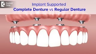 Advantages of Implant Supported Complete Denture  Dr Shahul Hameed  Doctors Circle [upl. by Raynah]