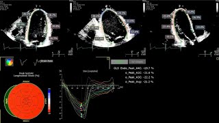 A Practical Guide to Echocardiographic Global Longitudinal Strain GLS by 2D Speckle Tracking [upl. by Arada536]