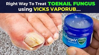 Best Toe Nail Fungus Treatments Onychomycosis Remedies [upl. by Marriott56]