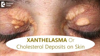 FATTY DEPOSITS of CHOLESTEROL around EYES  How to get rid of itDrRajdeep MysoreDoctors Circle [upl. by Little346]