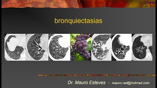 Bronquiectasias [upl. by Odin]