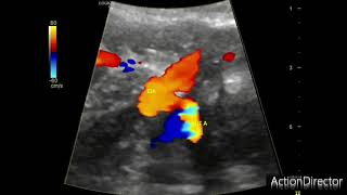 Obstetric Doppler ultrasound method of identifying the vessels [upl. by Lytton]