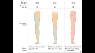 Lumbosacral radiculopathy [upl. by Lapides]