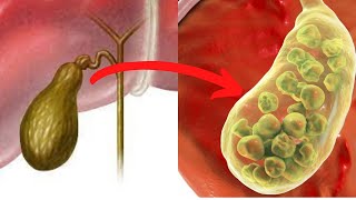 Warning Signs and Symptoms For Gallbladder Disease [upl. by Aiuqat]