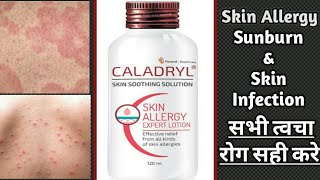 Caladryl Skin Soothing Lotion Review  Skin allergy infection itching amp Sunburn medicine [upl. by Donovan268]