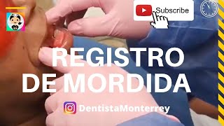 ⏩Registro de MORDIDA RODILLOS de CERA 👅QuickVideo ProtesisDental PPR MaterialesDentales [upl. by Ecnedurp493]