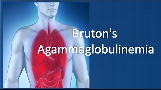 Brutons agammaglobulinemia [upl. by Robb291]