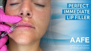 Perfect Immediate Lips  Lip Filler [upl. by Nallad]