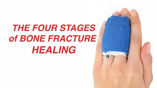 The Four Stages of Bone Fracture Healing [upl. by Anaehr961]