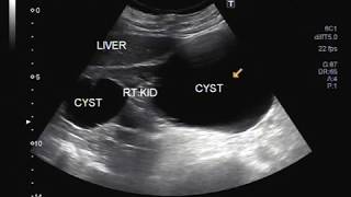 Ultrasound Video showing bilateral large simple renal cysts [upl. by Attelliw]