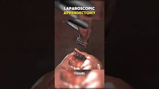 AppendicitisLaparoscopic Appendectomy🩺 [upl. by Esyle78]