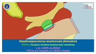 Hepaticojejunostomy anastomosis animation [upl. by Hotze]