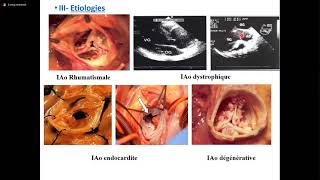 Insuffisance aortique [upl. by Netnerb]