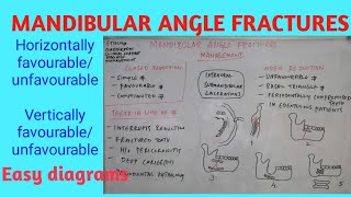 Mandibular angle fractures [upl. by Araas]