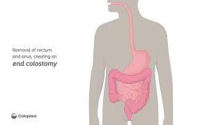 Creation of end colostomy by removing rectum and anus  Ostomy surgery  Coloplast India [upl. by Vere]