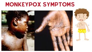 Monkeypox symptoms [upl. by Vasilis]