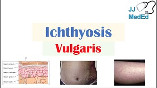 Ichthyosis Vulgaris  Causes Signs amp Symptoms Diagnosis Treatment [upl. by Lockwood]