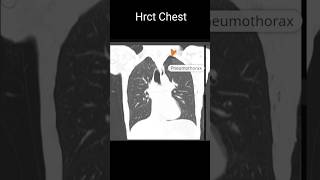 Pneumothorax shortfeeds [upl. by Laehpar870]