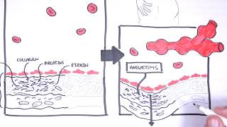 Polyarteritis Nodosa and Kawasaki Disease Medium Vessel Vasculitis  Symptoms pathophysiology [upl. by Bonner]