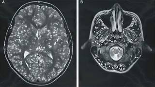 CISTICERCOSIS CAUSAS SÍNTOMAS Y TRATAMIENTO  EPILEPSIA POR CISTICERCOSIS  CISTICERCO CÓMO PREVENIR [upl. by Dorlisa]