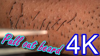 Beard removal tweezers super high quality zoom ASMR [upl. by Quartus]