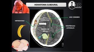 HEMATOMAS INTRACRANEALES EPIDURAL Y SUBDURAL  Como describir una Tomografía de cráneo [upl. by Kimball66]