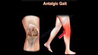 Painful Gait Antalgic Gait painful gait [upl. by Olivann]