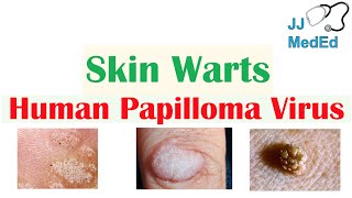 Overview of Skin Warts Verrucae  What Causes Them Who Gets Them  Subtypes and Treatment [upl. by Idyak]