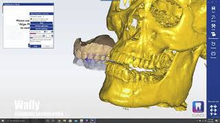 Condylar Inclination on CBCT [upl. by Ivens]