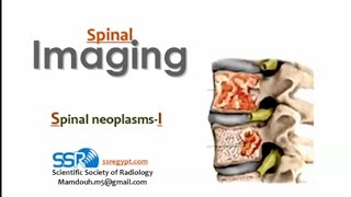 Imaging of Spinal Neoplastic lesions I DRE Prof Mamdouh Mahfouz [upl. by Zetta]