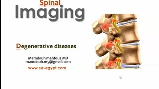 Spinal imaging Degenerative diseases I DRE Prof Mamdouh Mahfouz [upl. by Handy]