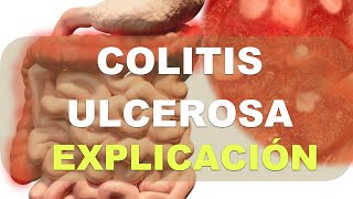 Colitis Ulcerosa en niños Explicación [upl. by Ogata]