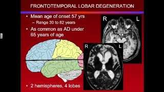 Overview of Frontotemporal Lobar Degeneration [upl. by Arimak]