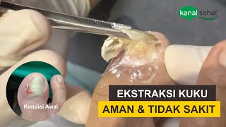 Pengangkatan Ekstraksi Kuku Cantengan [upl. by Azeel831]