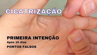 Cicatrização de Ferida por primeira intenção [upl. by Luann115]