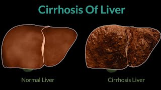 What is Cirrhosis of the liver l Symptoms Causes treatment l [upl. by Pancho]