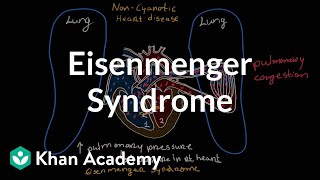 What is Eisenmenger syndrome  Circulatory System and Disease  NCLEXRN  Khan Academy [upl. by Lemmueu]