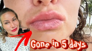 Angular Cheilitis gone in 5 daysLip eczemacracked lips red corners mouth SHOCKING FAST RESULTS [upl. by Filberte]