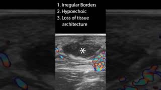 Characteristics of an Abscess pocus ultrasound [upl. by Meisel387]