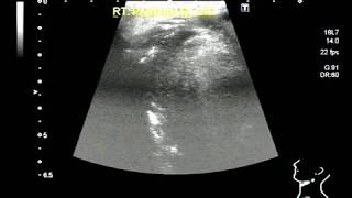 Ultrasound Video showing a small and illdefined mass in Parotid gland A rare case [upl. by Mackenie652]