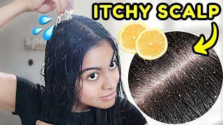 How I GET RID OF DANDRUFF in one hair wash lemon juice treatment [upl. by Sande547]