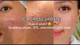 TCA CROSS UPDATE l ACNE SCARS [upl. by Samson896]