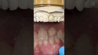 Replacing a chipped tooth lsk121shorts dentistteeth [upl. by Etnuahc19]