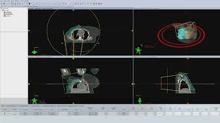 VMAT Technique for RightSide BreastCW Cancer with Flash Planning Radiotherapy [upl. by Yevoc]