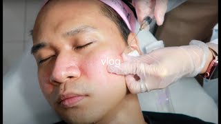 eng sub Acne Scar Treatment  Fractional RF  Subcision  PRP Filler Second Session Philippines [upl. by Dunseath]